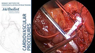 Download Lagu Iliac to SMA Bypass Ringed ePTFE (Alan B. Lumsden, MD) Thumbnail
