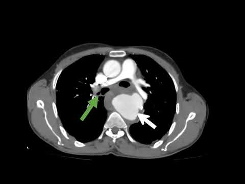 Thoracic Aneurysm with Mural Thrombi Causing Compression of Trachea , Esophagus, and Left Atrium