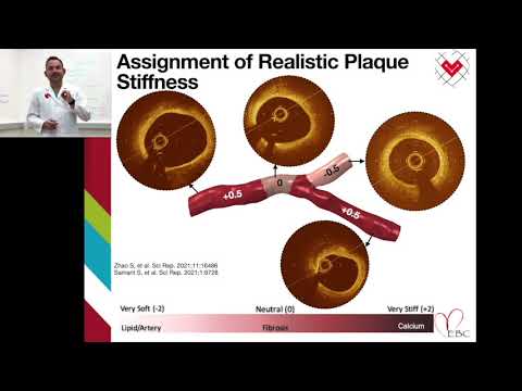 Patient-specific computational simulation of coronary artery bifurcation stenting