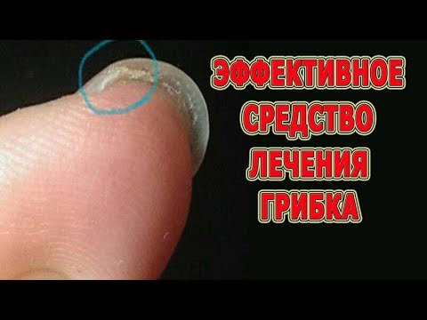 Wie die Größe der Nägel auf den Beinen bei gribke zu vergrössern 1 Stadium gribka auf den Nägeln
