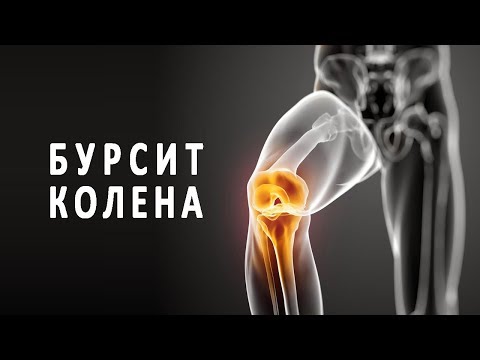 Что такое бурсит коленного сустава и как он лечится?