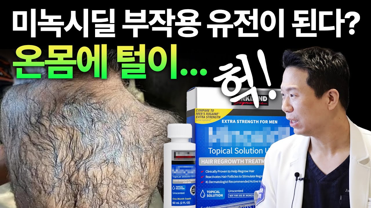 涂米诺地尔地话一定要看地视频。 孩子身上长毛！