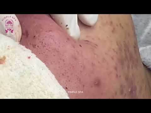 Acne Extraction So Deep – From Nose to Mouth, This Pus Never Stopped (Part 2) – Pimple Spa