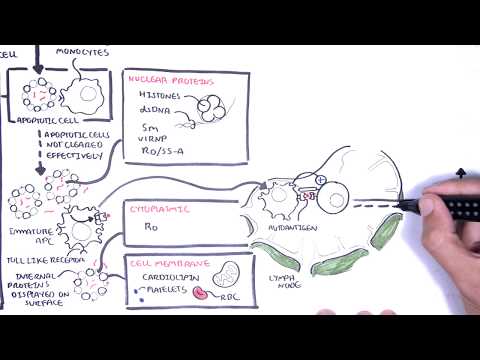 Lupus eritematoso sistémico (LES) - signos y síntomas, fisiopatología, investigaciones, tratamiento