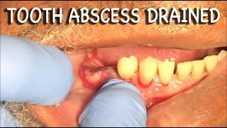 Infected Tooth Abscess Drained | Graphic⚠️