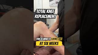 What a TOTAL KNEE REPLACEMENT LOOKS LIKE (at 6 weeks post-op)