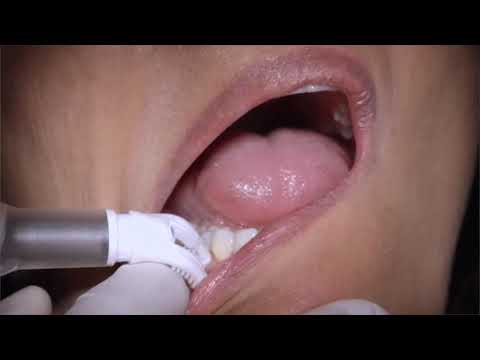Dr. David Ching, DMD demonstrates using the DentalVibe on adult patients