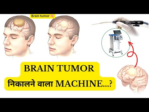 Brain Tumor 🧠 निकालने वाला CUSA Machine.?||MedicalEdutech|| Brain tumor|CUSA