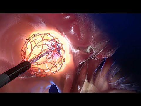 Video Thumbnail: Tief im Herzen: ein medizinischer Durchbruch der EU bei Herzrhythmusstörungen