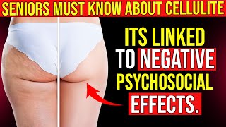 How To Get Rid Of Cellulite On Thighs & Buttocks FAST  -  Doctor Reveals Real Solution!