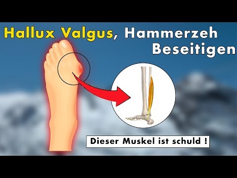 3 exercises for hallux valgus, hammer toe, and bunion | The TRUE cause & solution