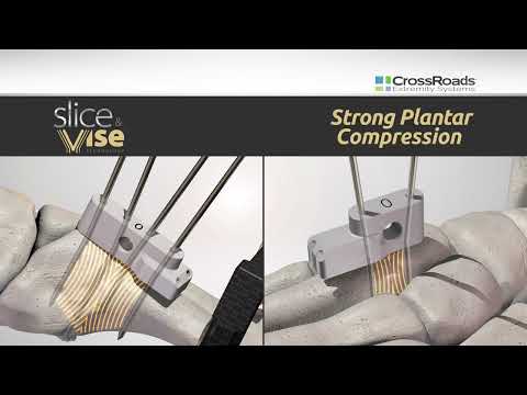 Slice & Vise™ Technology - Part of the dynaBunion® 4D Lapidus and DynaMet™ Lesser TMT Systems