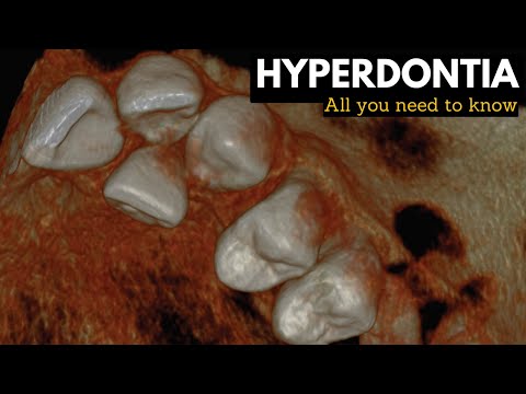 Hyperdontia, Causes, Signs and Symptoms, Diagnosis and Treatment.