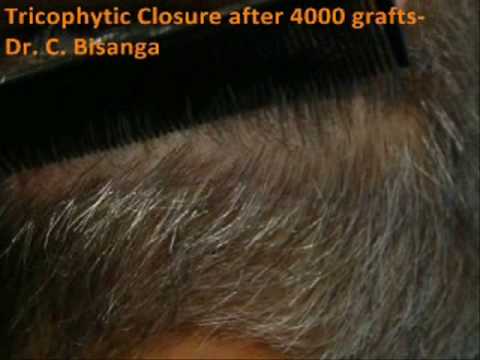 Dr. Bisanga FUT/Tricophytic Closure Technique