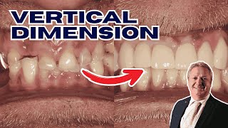 Steps for Increasing the Vertical Dimension of Occlusion with David Bloom - PDP232