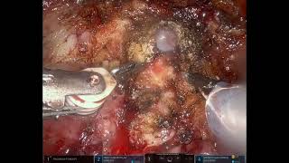 Asvide: Combined robotic assisted laparoscopic and perineal approach to complex posterior urethral..