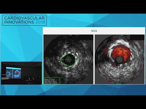 CVI2018 Session: Proximal right coronary artery undilatable lesion - Peter Tajti, MD