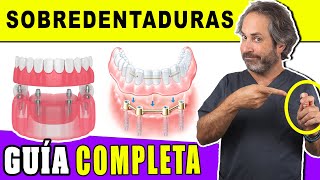 La 𝗠𝗘𝗝𝗢𝗥 y MÁS 𝗕𝗔𝗥𝗔𝗧𝗔 Prótesis Removible sobre Implantes:  𝗦𝗢𝗕𝗥𝗘𝗗𝗘𝗡𝗧𝗔𝗗𝗨𝗥𝗔 sobre 4 IMPLANTES LOCATOR