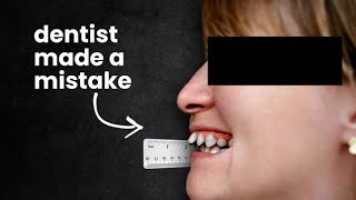 The dentist made a mistake…excessive overbite correction