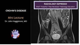 CROHN’S DISEASE: Case Example – Acute Crohn’s disease on MRI (4340)