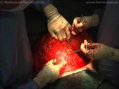 Laparoskopische Reparatur der postoperativen Hernie Und Bauchdeckenstraffung (Abdominoplastik)