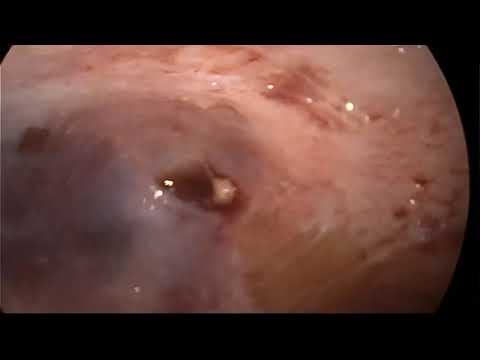 Treatment for intraductal papilloma