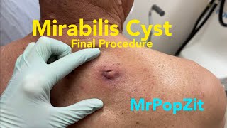 Final procedure! Giant Proteus Mirabilis abscess/infected cyst. Cyst reformed and I remove it.