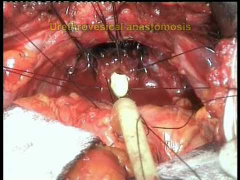 Radical Prostatectomy - Fast Continence Recovery