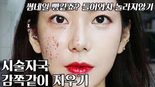 [Eng](피부커버 끝판왕)시술 자국,여드름 흉터 완벽 커버하기! +새살침 질문 받아요 (썸네일 뻥같죠? 들어와서 놀라지마요) / 깡나