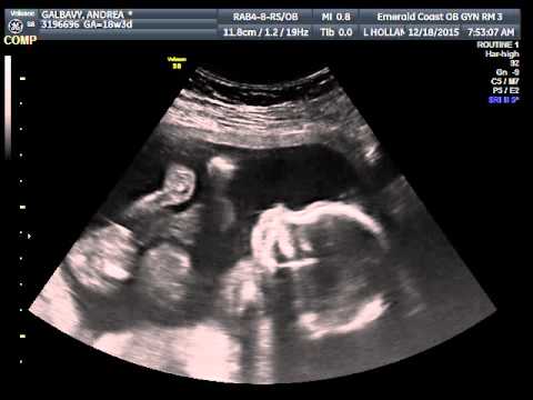 2015-12-18 Andrea Baby Ultrasound 1
