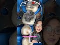 Dentist Does A Silver Filling Filling Cavity Silverfilling Dentist