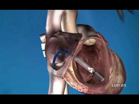 Marcapasos sin cables (Clínica Universidad de Navarra)