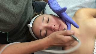 Microdermabrasion in Irvine | Newport Face N Body MedSpa