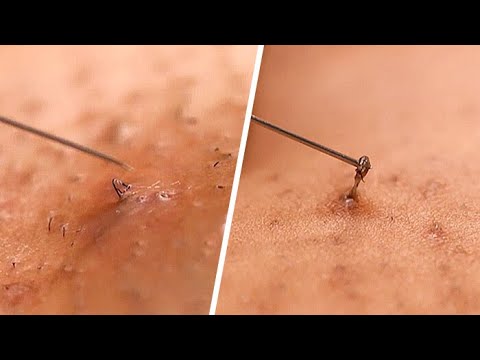 Ingrown Hair Removal Guide | Beauty Studio