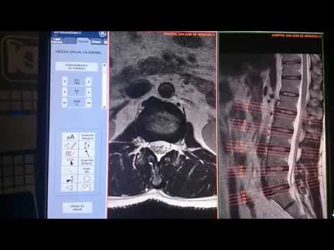 Dolor en las articulaciones de rodilla Tratamiento de la rodilla inflamada remedios populares conjunta
