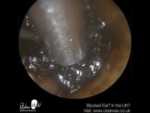 1,381 - Last Hope Ear Wax Removal for Patient in a lot of Discomfort