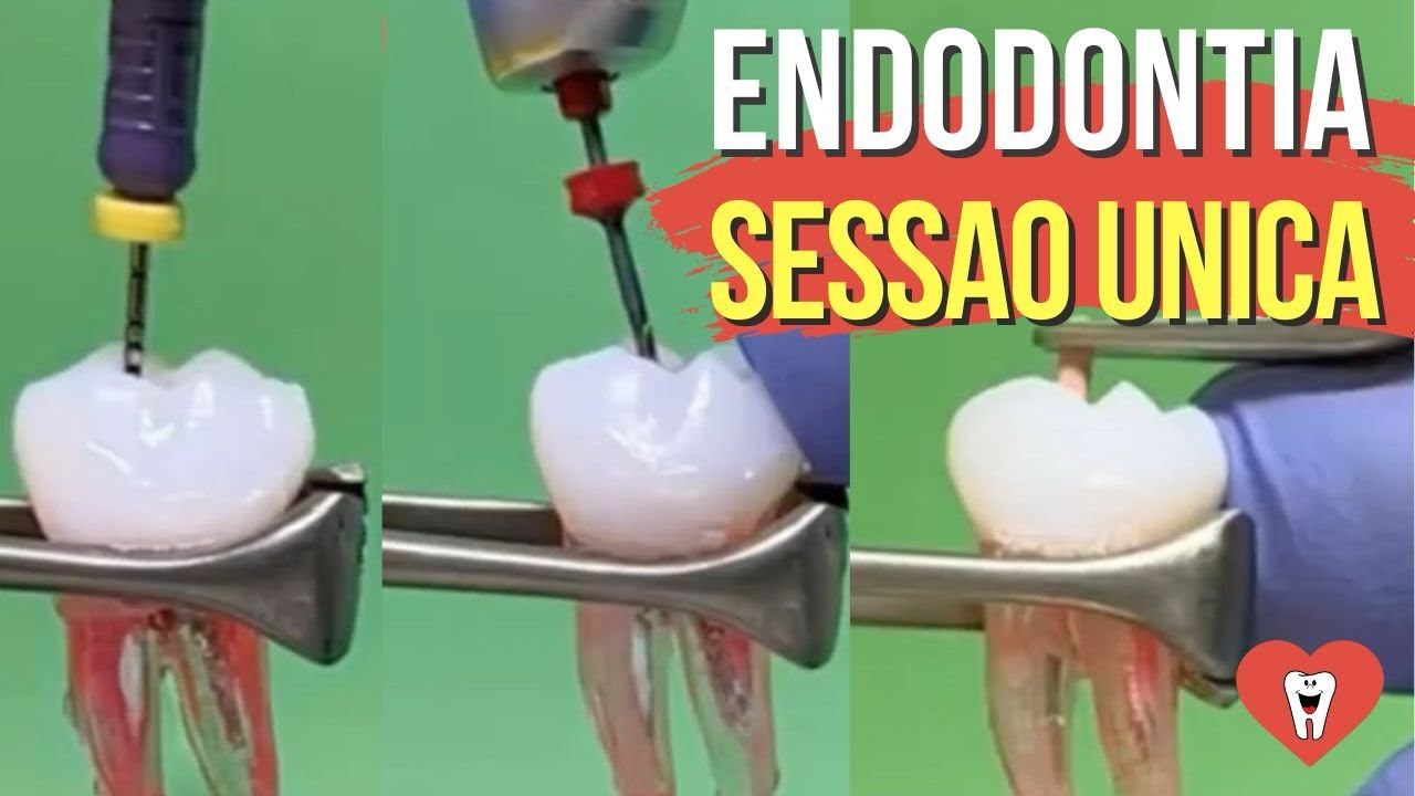 ENDODONTIA SESSÃO ÚNICA PASSO A PASSO