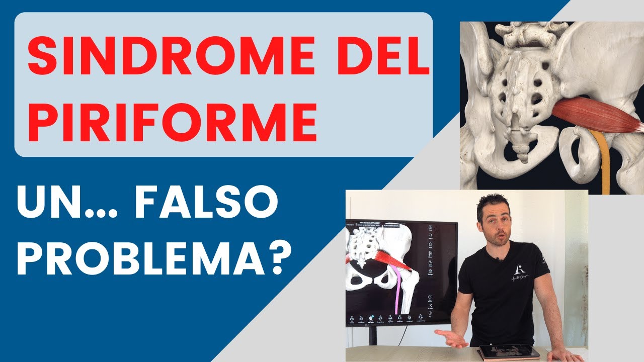 Watch Now Sindrome del PIRIFORME: un.... falso problema Sindrome del PIRIFORME: un.... falso problema
