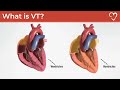 What is Ventricular Tachycardia (VT)?