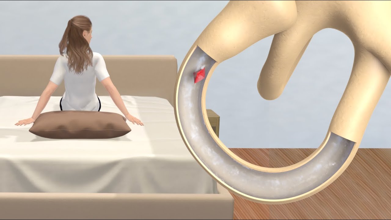 Epley Maneuver to Treat BPPV Dizziness