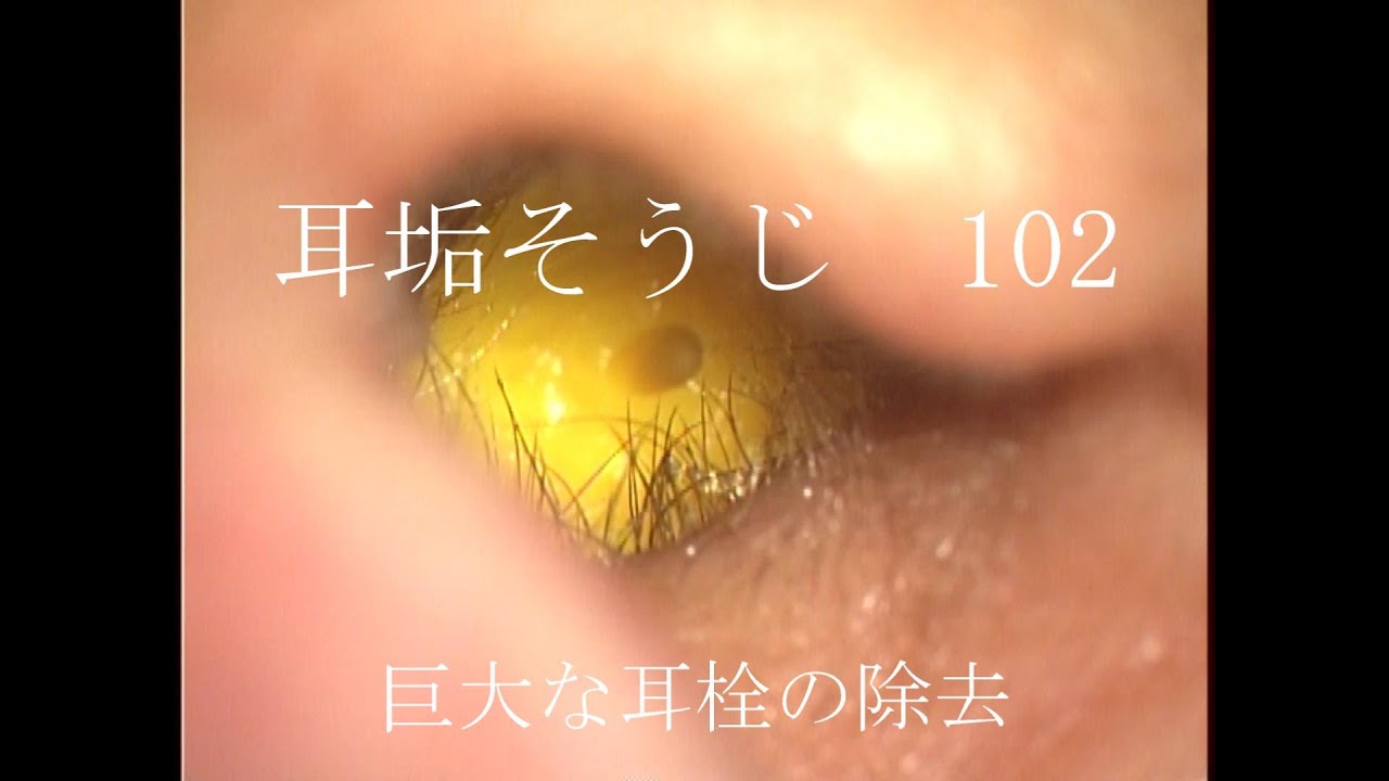 耳垢そうじ/外耳道に陥入した巨大な耳栓/102