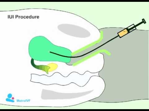 IUI procedure