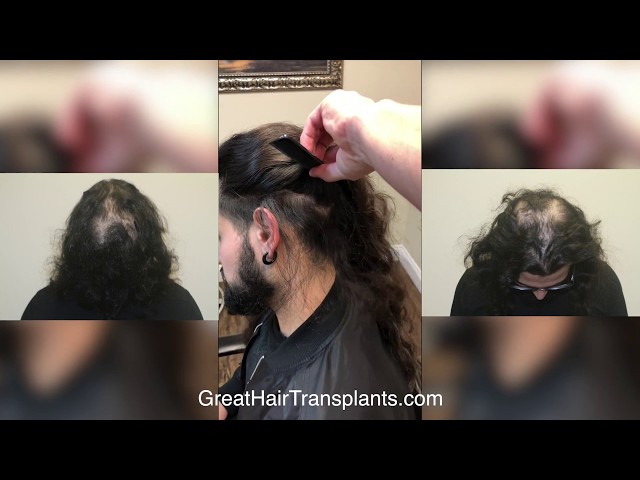 Dr. Brett Bolton Patient Ali MaxHarvest&trade;
