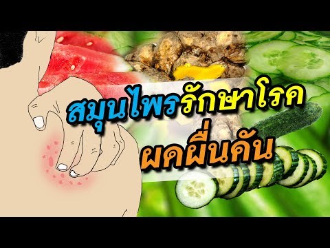 บอกว่าไม่มีกลาก รีสอร์ทในพื้นที่รักษาคิรอฟของโรคสะเก็ดเงิน