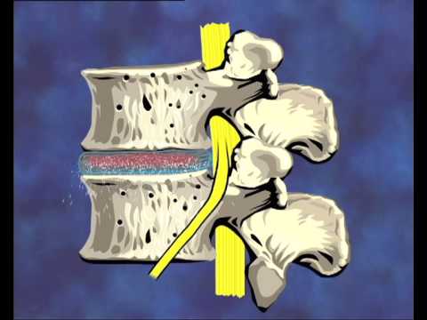 Kopfschmerzen Osteochondrose was trinken Tabletten Die Größe des Verbandes auf dem Kniegelenk