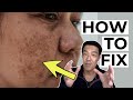 How Do Dermatologists FIX Pigmentation PIH