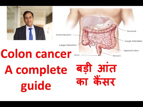 Best Colon Cancer Treatment in India