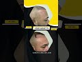 Hair Transplant In Our Patient 2500 Grafts Care4Hair