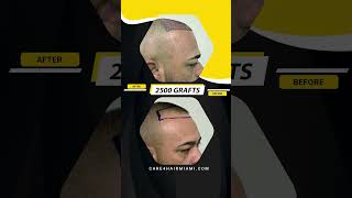 Hair Transplant in our patient. 2500 grafts | Care4Hair