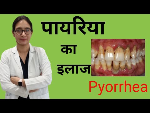 pyorrhea treatment at home//पायरिया का घरेलू इलाज // cure of pyorrhea//periodontitis treatment